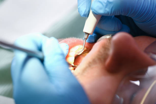 Best Dental Abscess Treatment in Glasgow, KY